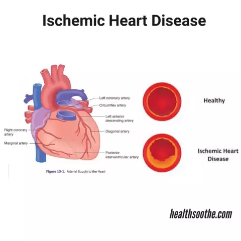 Ischemic heart disease: sintomas, sanhi, pag-iwas