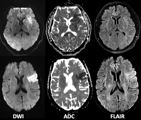 ONMK: what is it? ONMK on ischemic type. Federal register of patients with stroke