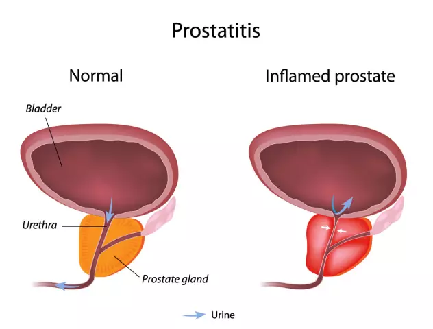 Diagnosis of prostatitis in men - what you need to know?