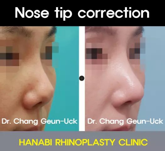 Correction of the tip of the nose: reviews. Rhinoplasty in Moscow