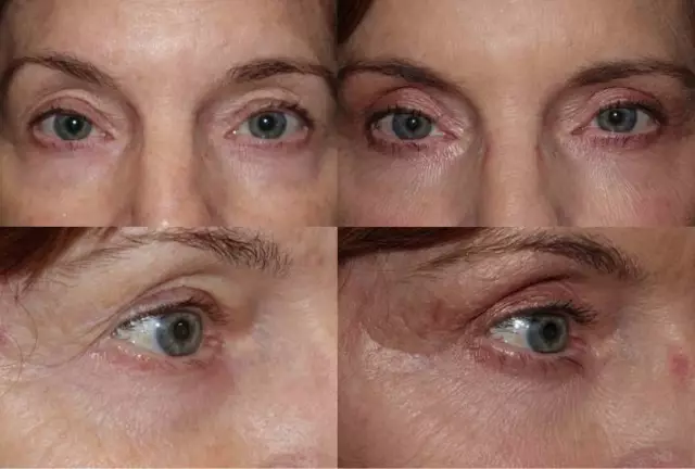 Blepharoplasty of the upper eyelids: rehabilitation, complications, photos