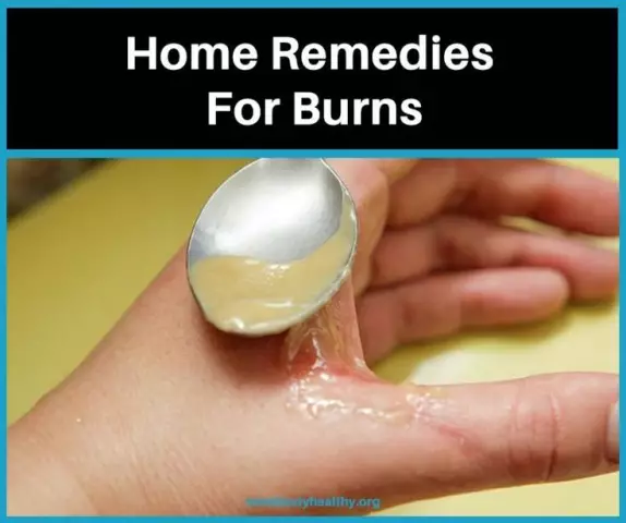 What kind of burn remedy can be used