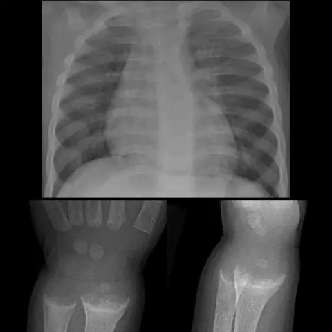 Lack of which vitamin leads to rickets: C or D?