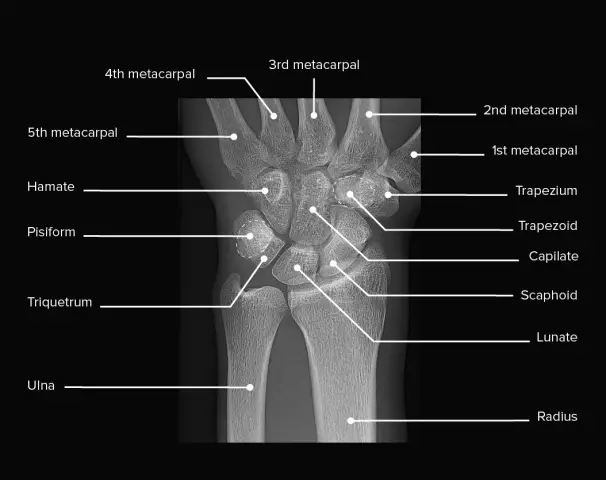 Key concepts affecting the bones of the wrist and pain in this area