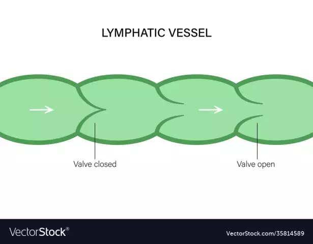 Superficial lymphatic vessel. human lymphatic vessels. Diseases of the lymphatic vessels