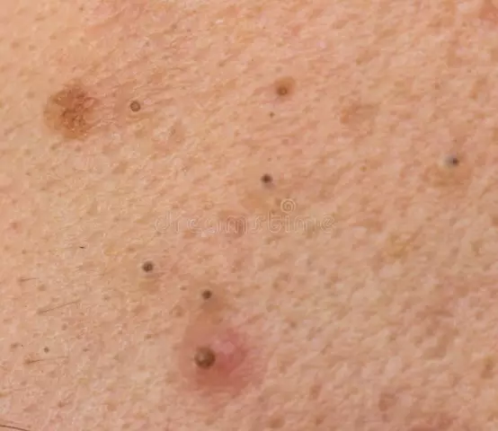 Squeezing black dots on the face in the salon and at home