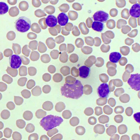 Increased lymphocytes in the blood: features, causes and consequences