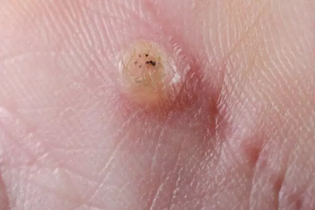 How to get rid of warts on the hands: basic methods