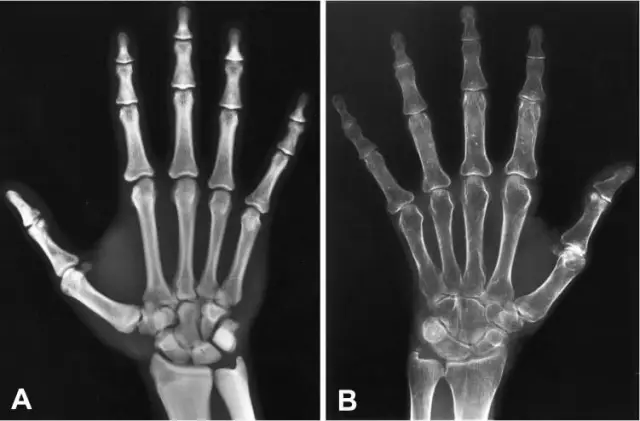 Kemik dansitometrisi ve osteoporoz - hastalığı önceden bilmek için başka bir şans