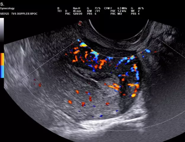 What does a gynecological ultrasound mean?