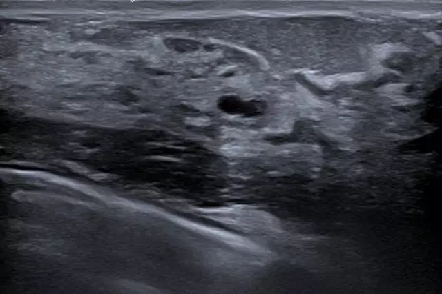 Mammography or Breast Ultrasound? Examination of the mammary glands. Price, reviews