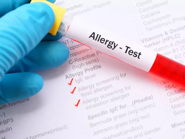 Allergy testing. Where to do allergy tests for children