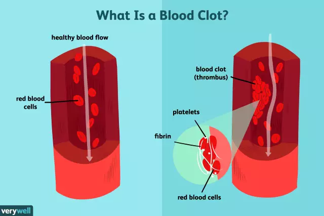 What thins the blood and prevents blood clots