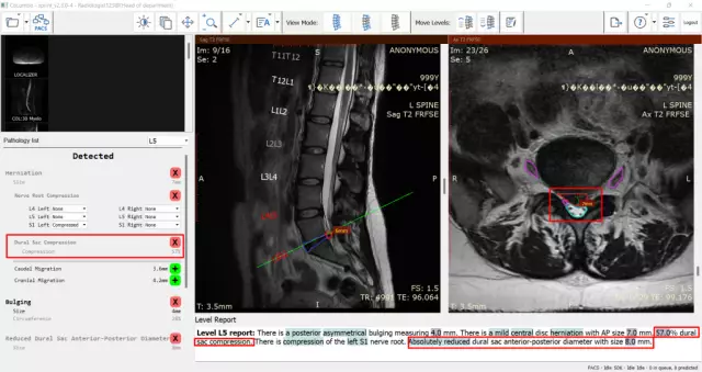 What is a dural sac?