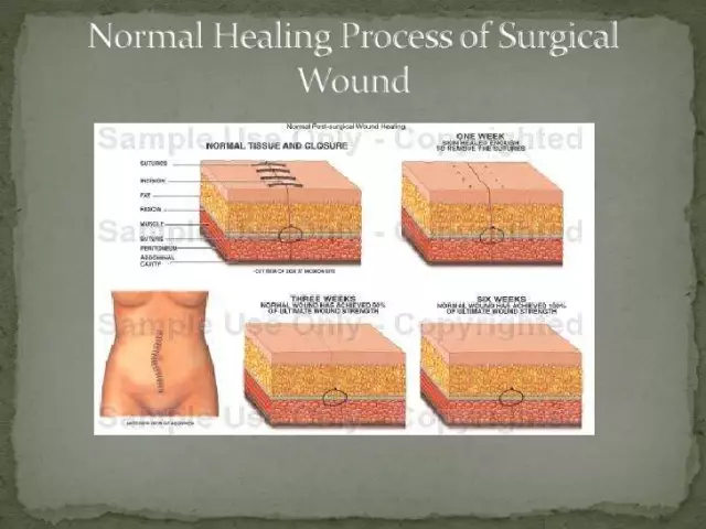 Primary surgical treatment of wounds is a serious obstacle to infection