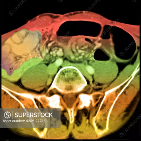 What will the computed tomography of the intestine show? How to prepare and where is it better to do an intestinal tomography in Moscow