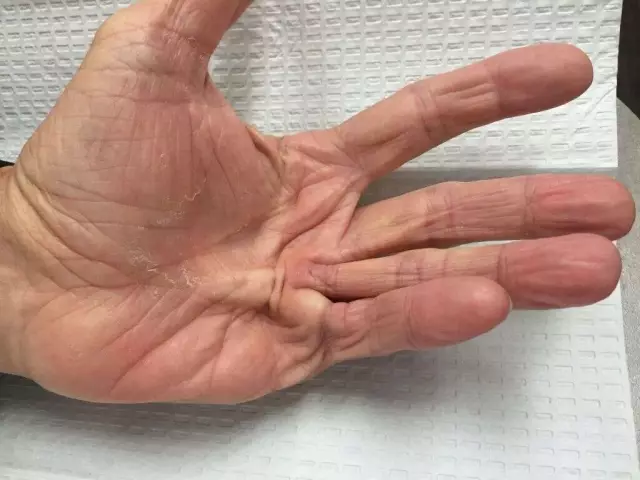 What are the causes of shaky hands?