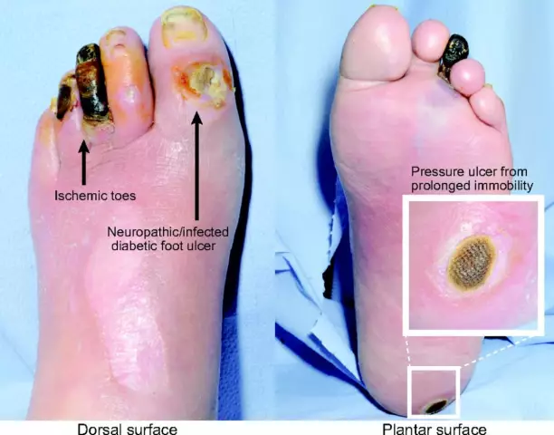 Diabetic foot: symptoms and classification