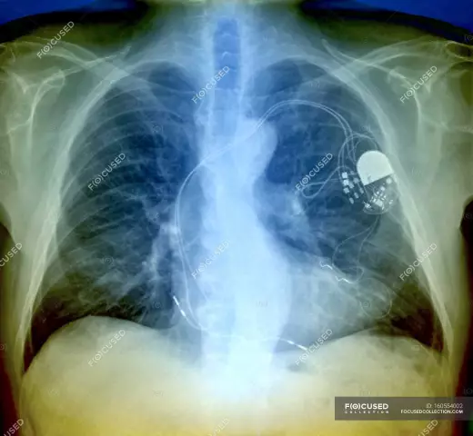 Heart pacemaker: contraindications. Rules of conduct for a patient with a pacemaker