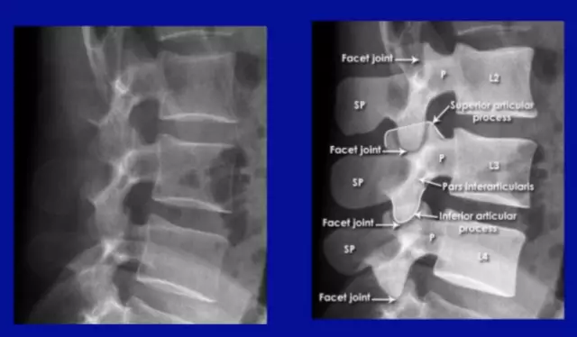 X-ray of the lumbar spine: purpose, features and interpretation