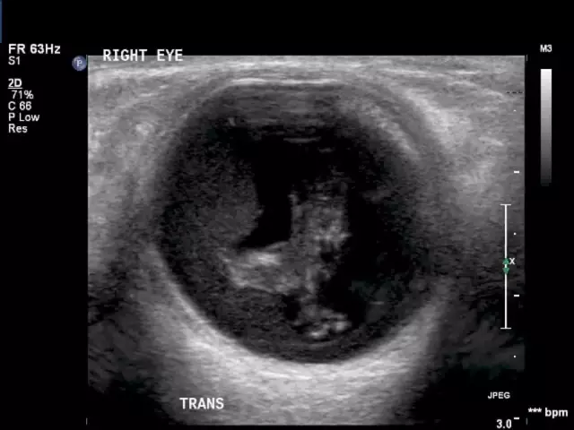 Echografie van het oog: hoe het wordt gedaan en wat het laat zien. Oogheelkundig centrum