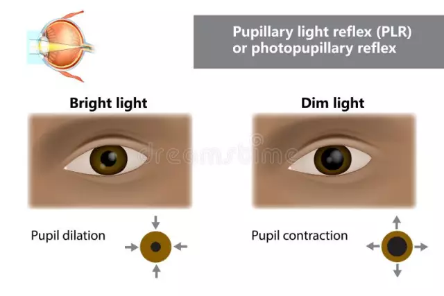 Pupillary reflex and signs of its defeat