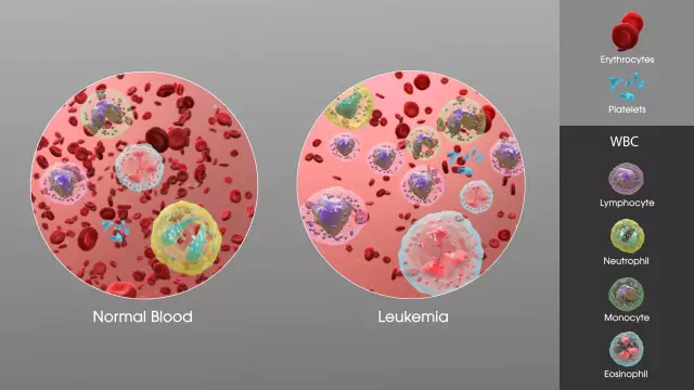 Inflamacioni i irisit: shkaqet, simptomat, diagnoza, trajtimi dhe parandalimi