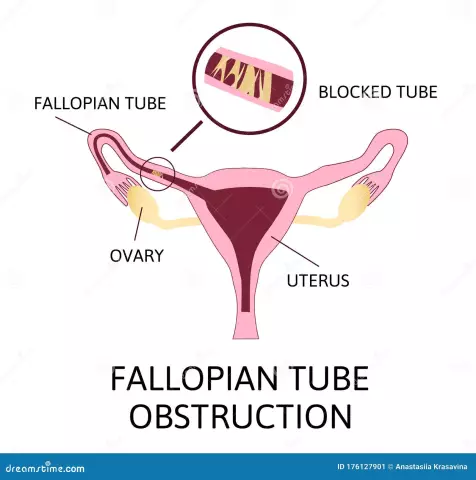 Fallopian tube in women - what is it? Inflammation of the fallopian tubes. Obstruction of the fallopian tubes