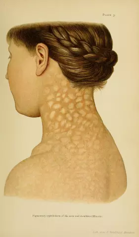 The main symptoms of syphilis in women