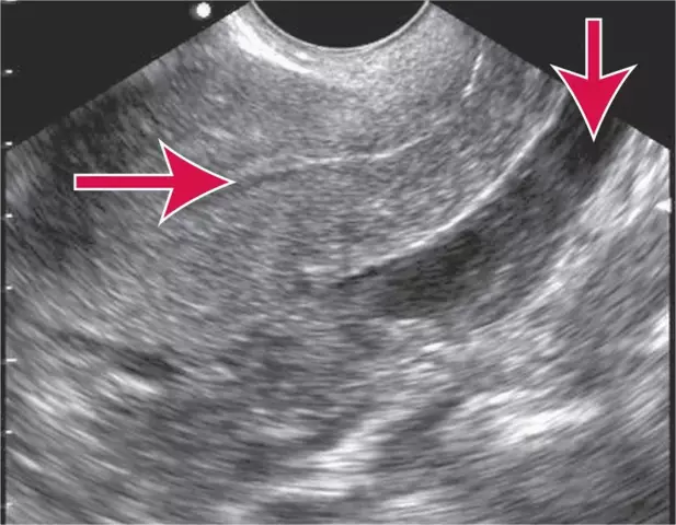 Ultrasound of the uterus: how they do it, what it shows, decoding the results