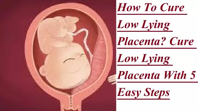 Low placenta - causes and consequences