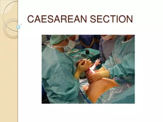 Caesarean section: reviews and more