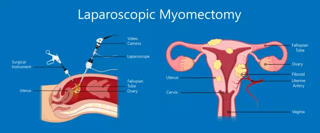 Myomectomy: patient reviews, indications and consequences